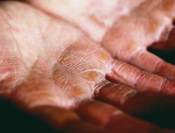 Cara Ampuh Mengatasi Kulit Kering dari Wajah hingga Tubuh