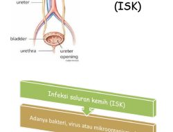 Gejala dan Pencegahan Infeksi Saluran Kemih oleh Dokter Urologi Kendari